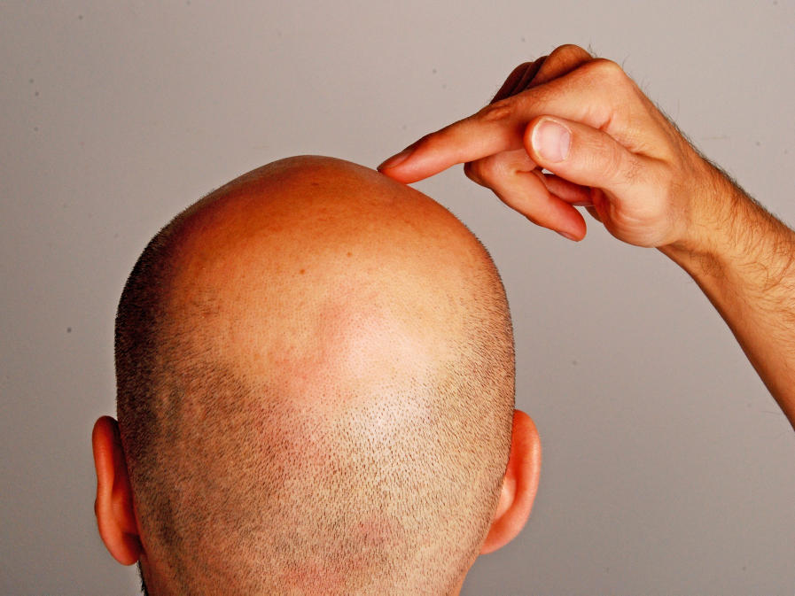 Androgene Alopezie