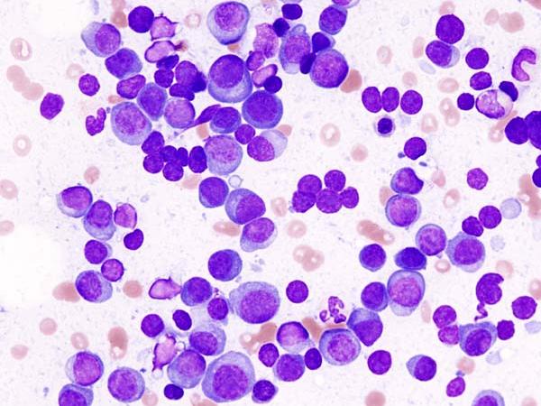 Multiples Myelom